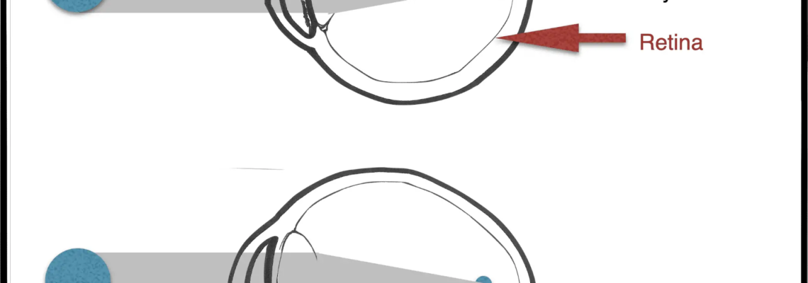 Myopia Progression Control
