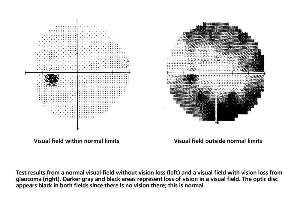 GUIDE TO VISUAL FIELD PRINTOUT INTERPRETATION